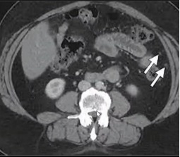 Ovarian Cancer ML Classification